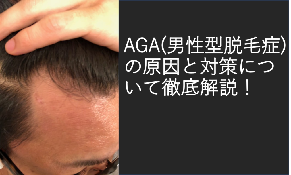 AGA(男性型脱毛症)の原因と対策について徹底解説！